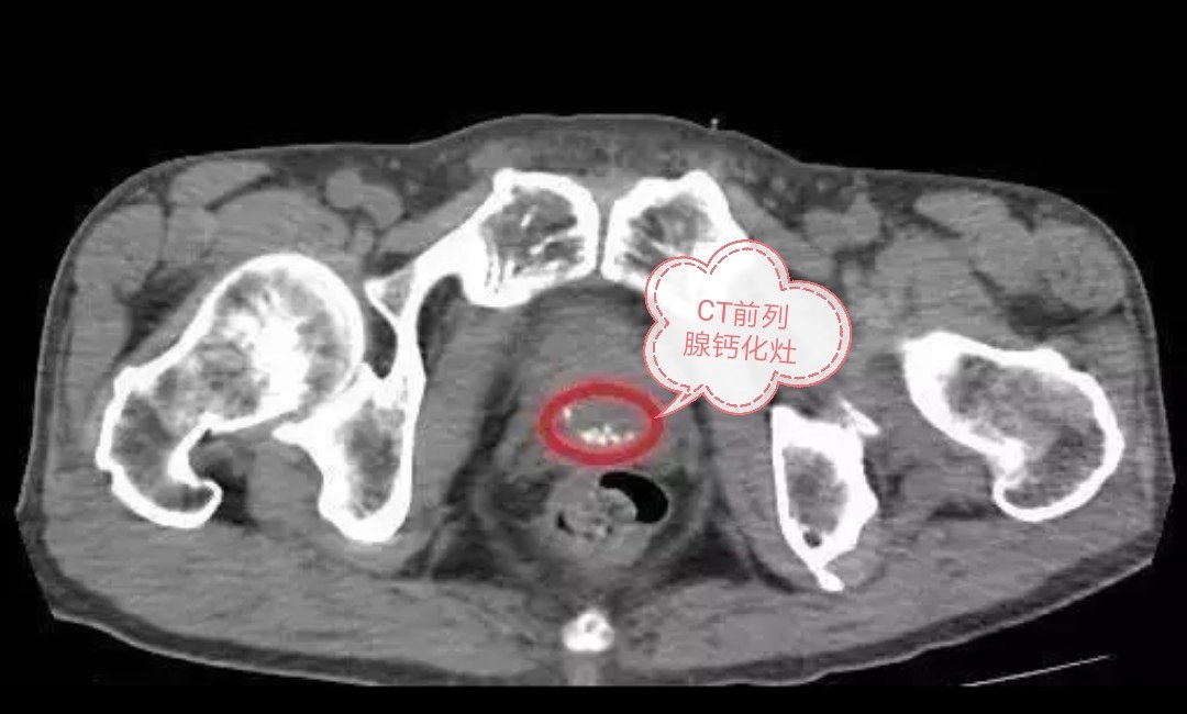 前列腺钙化彩超图片
