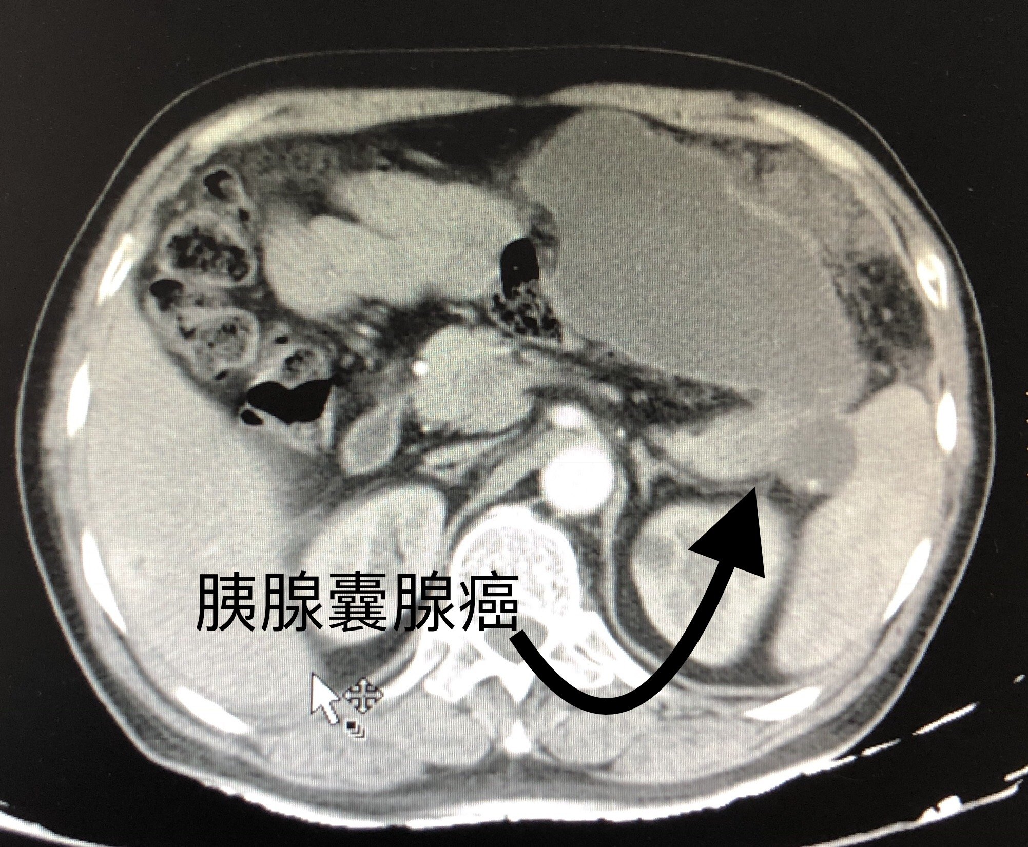 胰腺囊腺癌图片