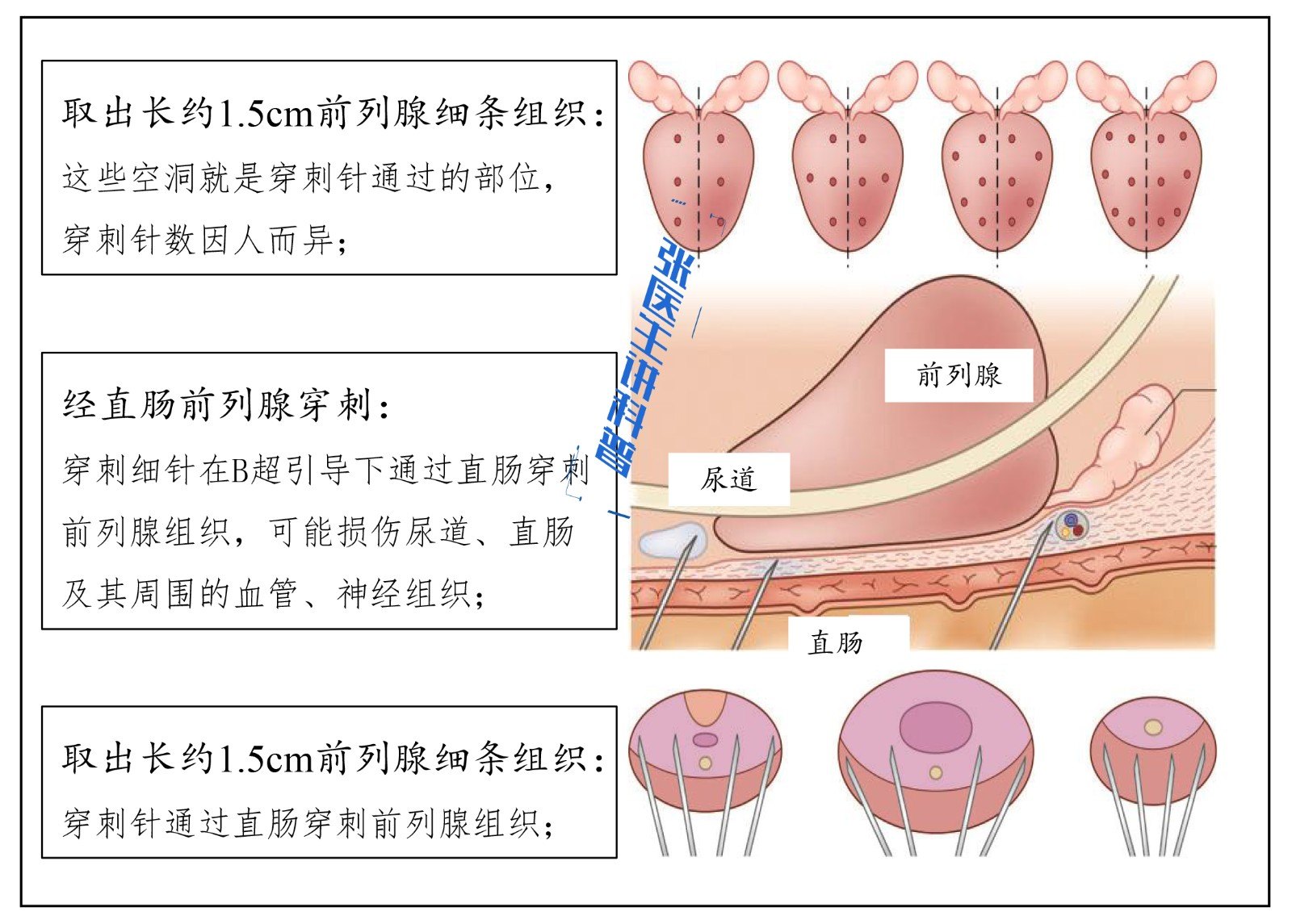 前列腺穿刺部位示意图图片