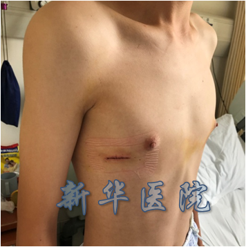 鸡胸微创手术治疗系列-11 - 好大夫在线