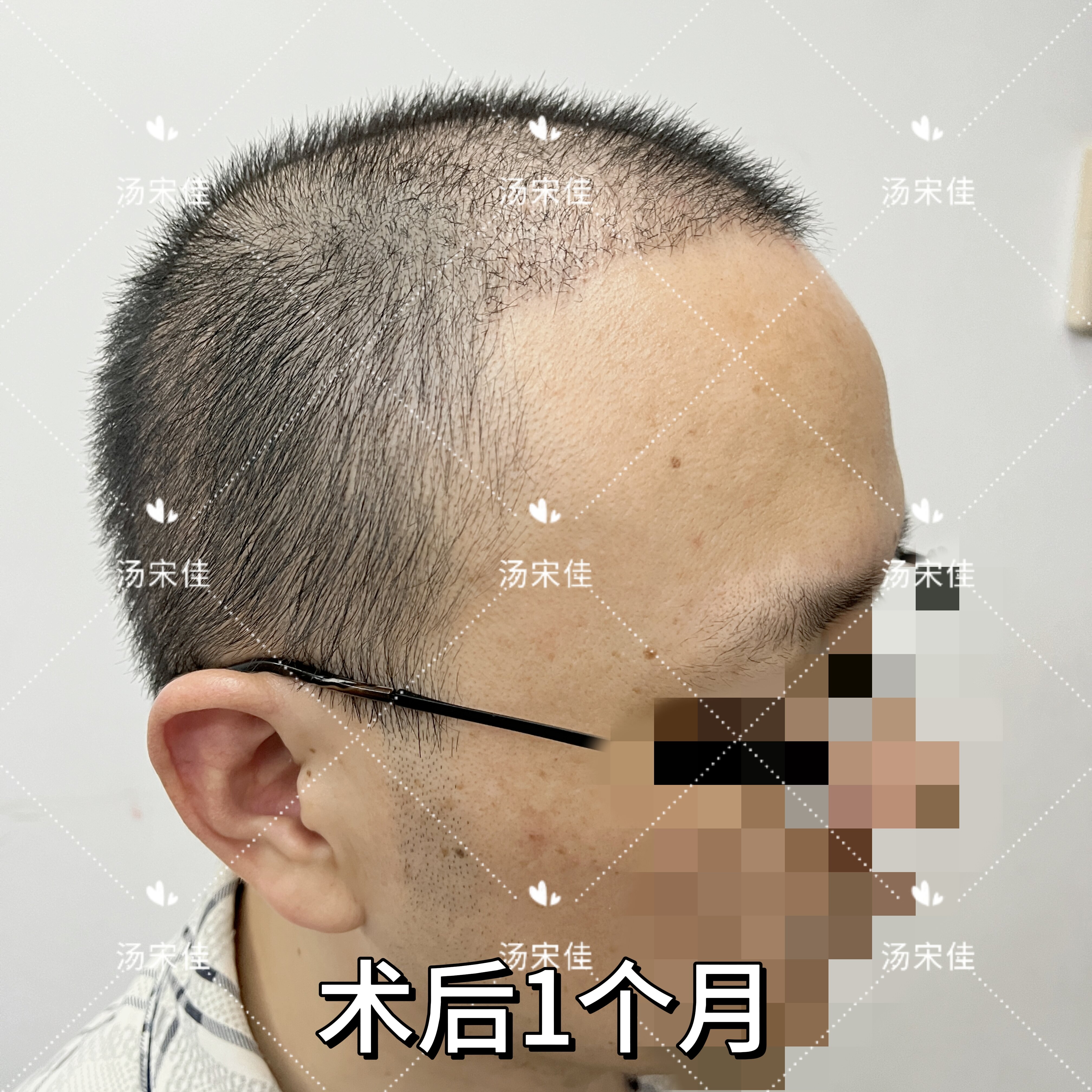 男性头顶加密植发1年后枕3000胡须1000单位