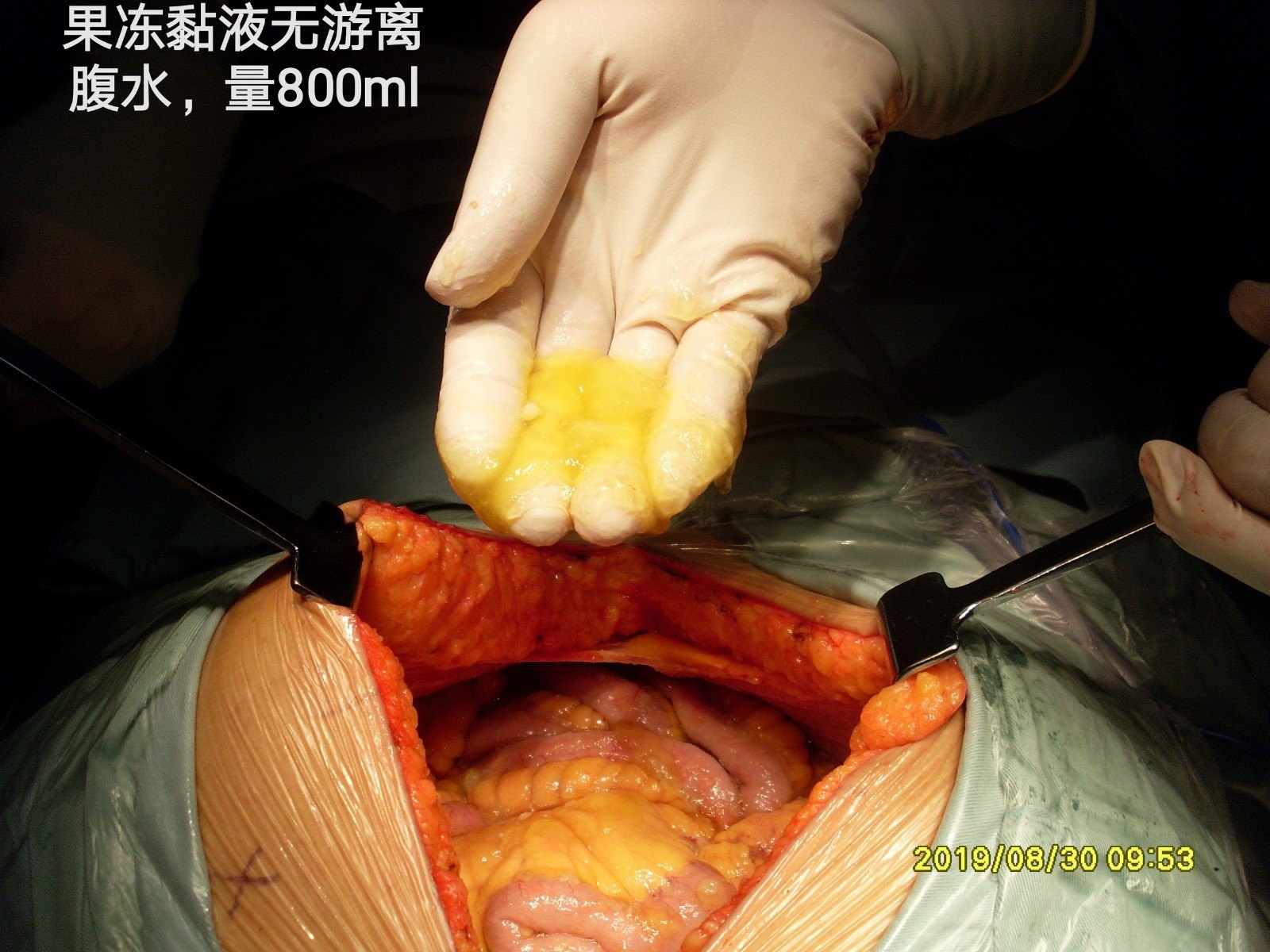 实施手术方案:双侧腹膜,盆腔腹膜,子宫双附件,douglas窝,全大网膜