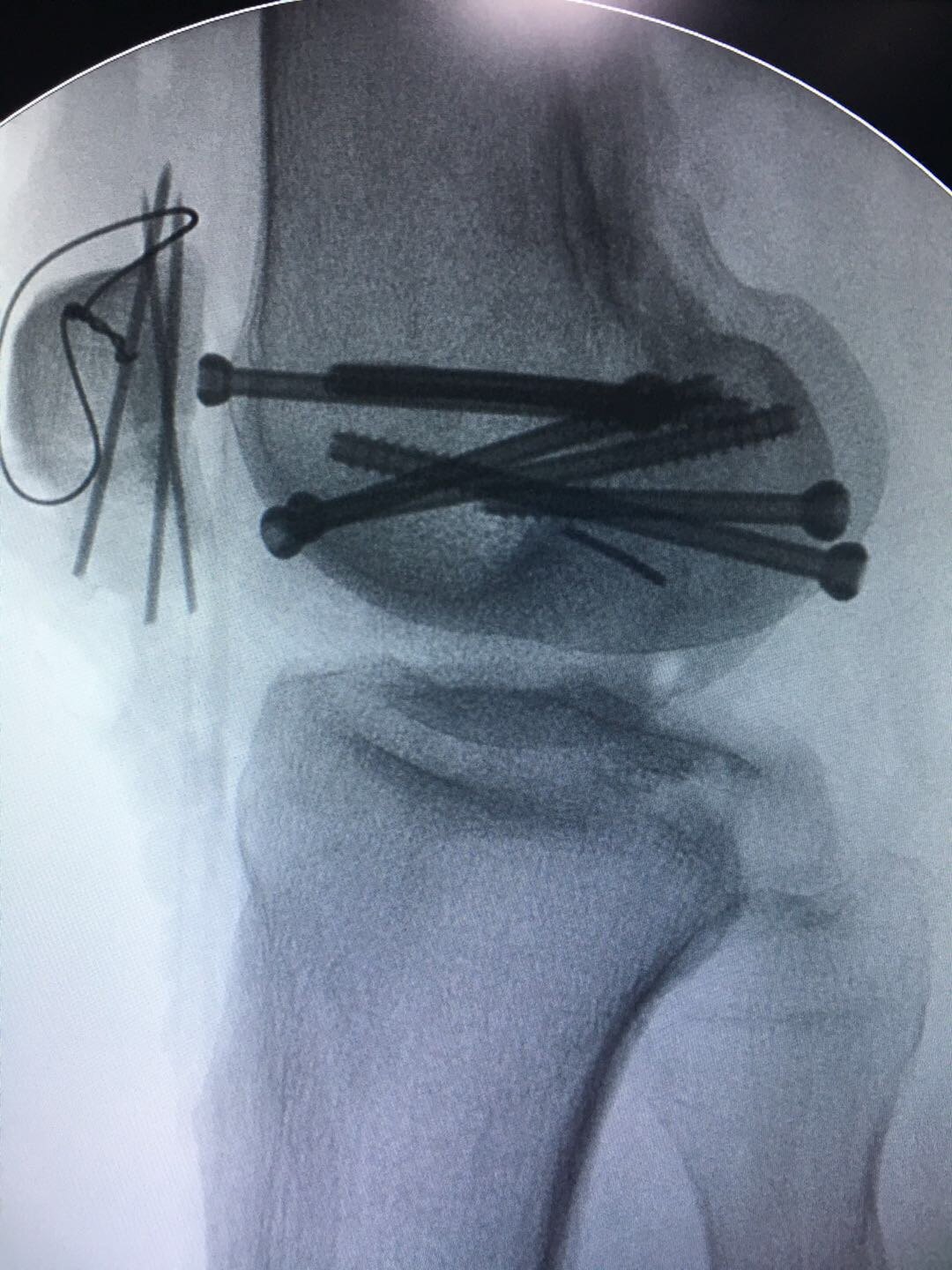 一种少见的骨折—hoffa骨折 - 好大夫在线