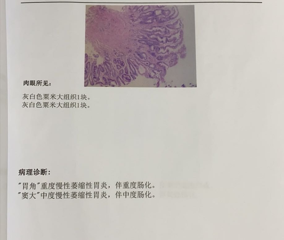 不得不为 重度萎缩 的问题专门跟病理科主任讨论了很久 慢性萎缩性胃炎 慢性萎缩性胃炎 不得不为 重度萎缩 的问题专门跟病理科主任讨论了很久 慢性萎缩性胃炎 慢性萎缩性胃炎