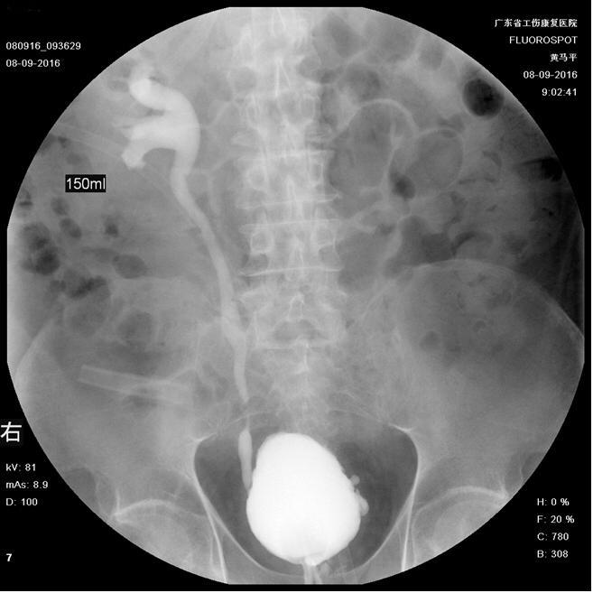 我脊柱骨折,你怎么让我住泌尿科了