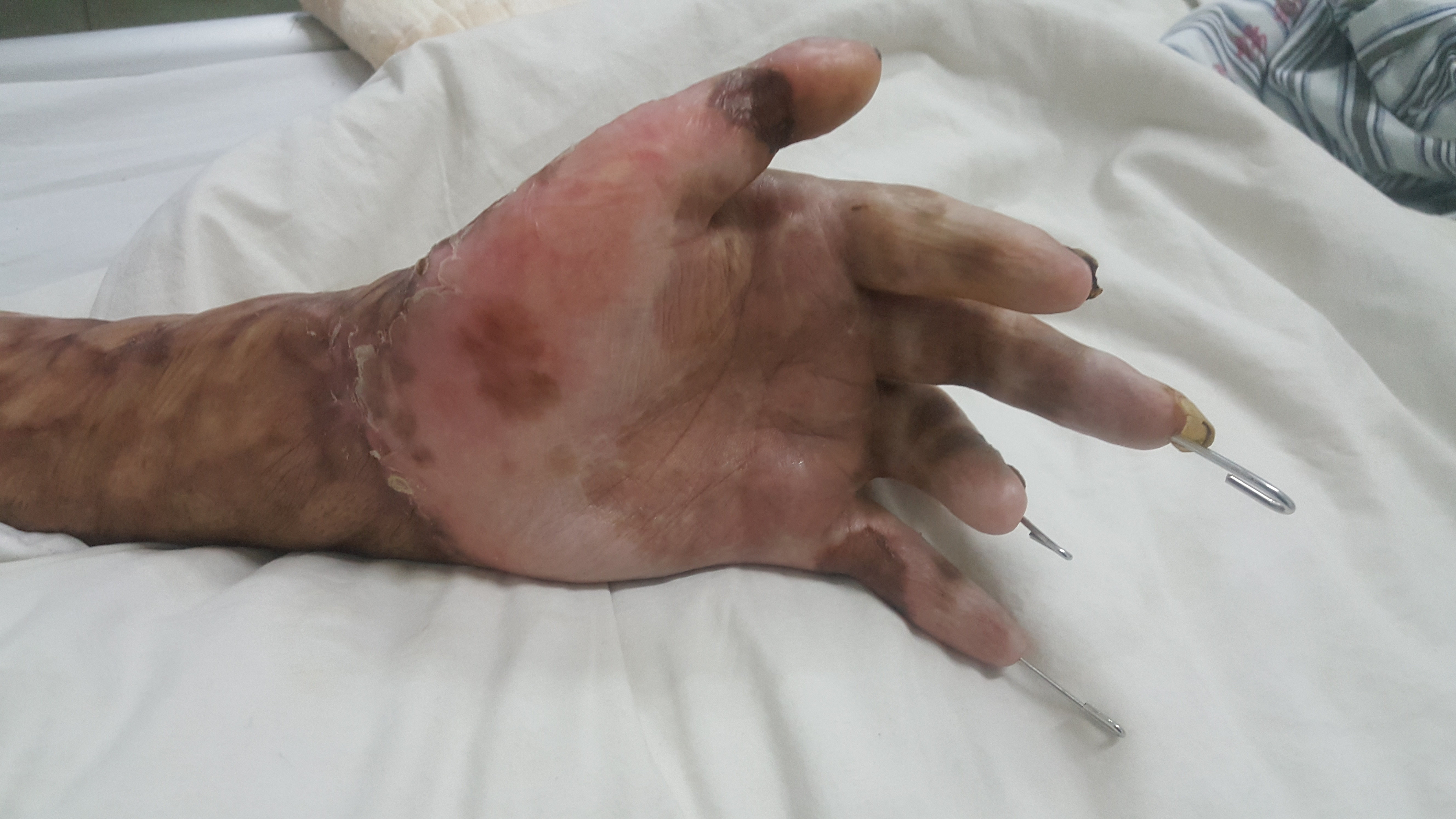 烧伤后指屈瘢痕畸形 - 好大夫在线