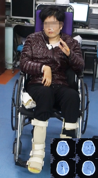 状血管瘤出血后继发脑积水,经5家医院治疗后病情恶化:昏迷,双下肢瘫痪