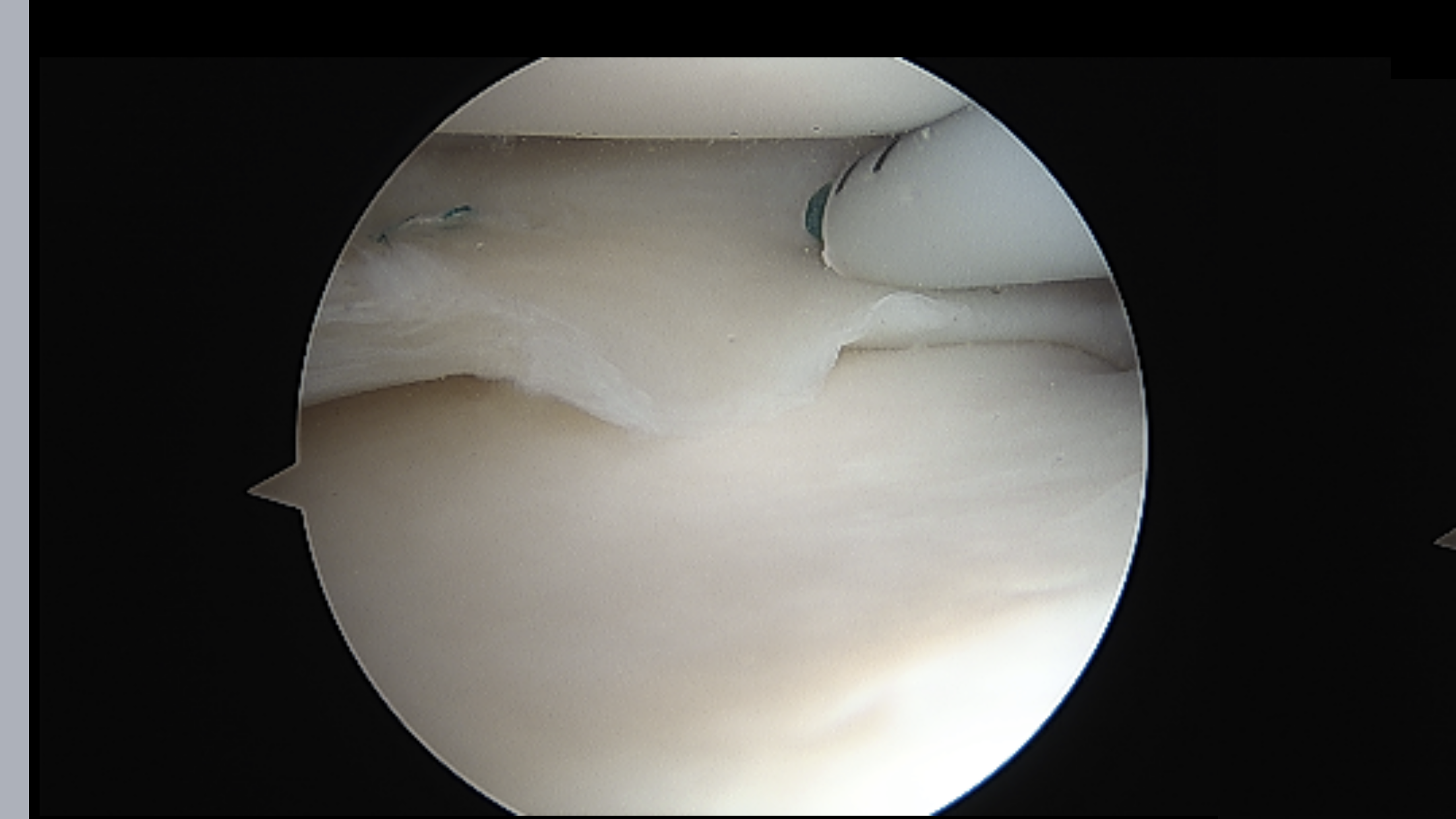 骨髓刺激prp局部新鲜化三管齐下保住半月板 好大夫在线 骨髓刺激prp局部新鲜化三管齐下保住半月板 好大夫在线