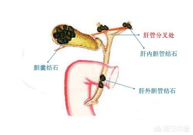 你的胆囊手术是怎么做的 胆结石都长在哪里 胆结石 胆结石