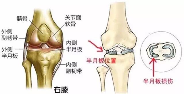 膝关节内侧半月板损伤图片