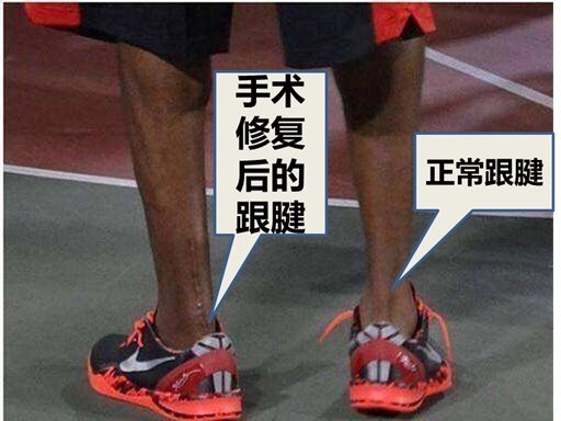 跟腱断裂是怎么回事 跟腱断裂 跟腱断裂是怎么回事 跟腱断裂