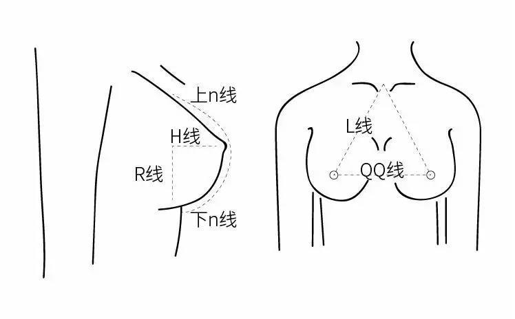 隆胸手术术前画线图片