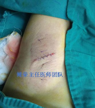 微创小切口腋臭切除术图解