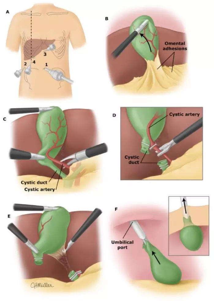 详解腹腔镜下胆囊切除术 胆囊切除术 胆囊切除术