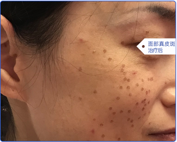 乘过年空闲做激光祛斑不信你看她的祛斑真实恢复记录