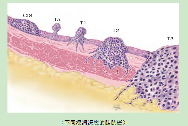 患者膀胱全切前到底要不要做全身化疗