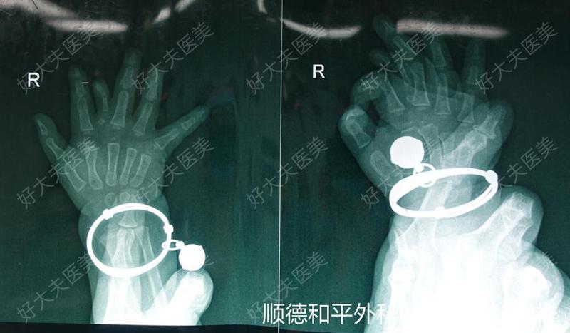 先天性并指多指畸形_先天性并指多指畸形 - 好大夫在线
