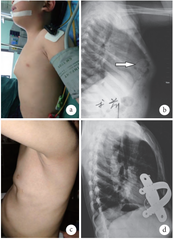 微创一期治疗儿童鸡胸合并胸骨后疝一例
