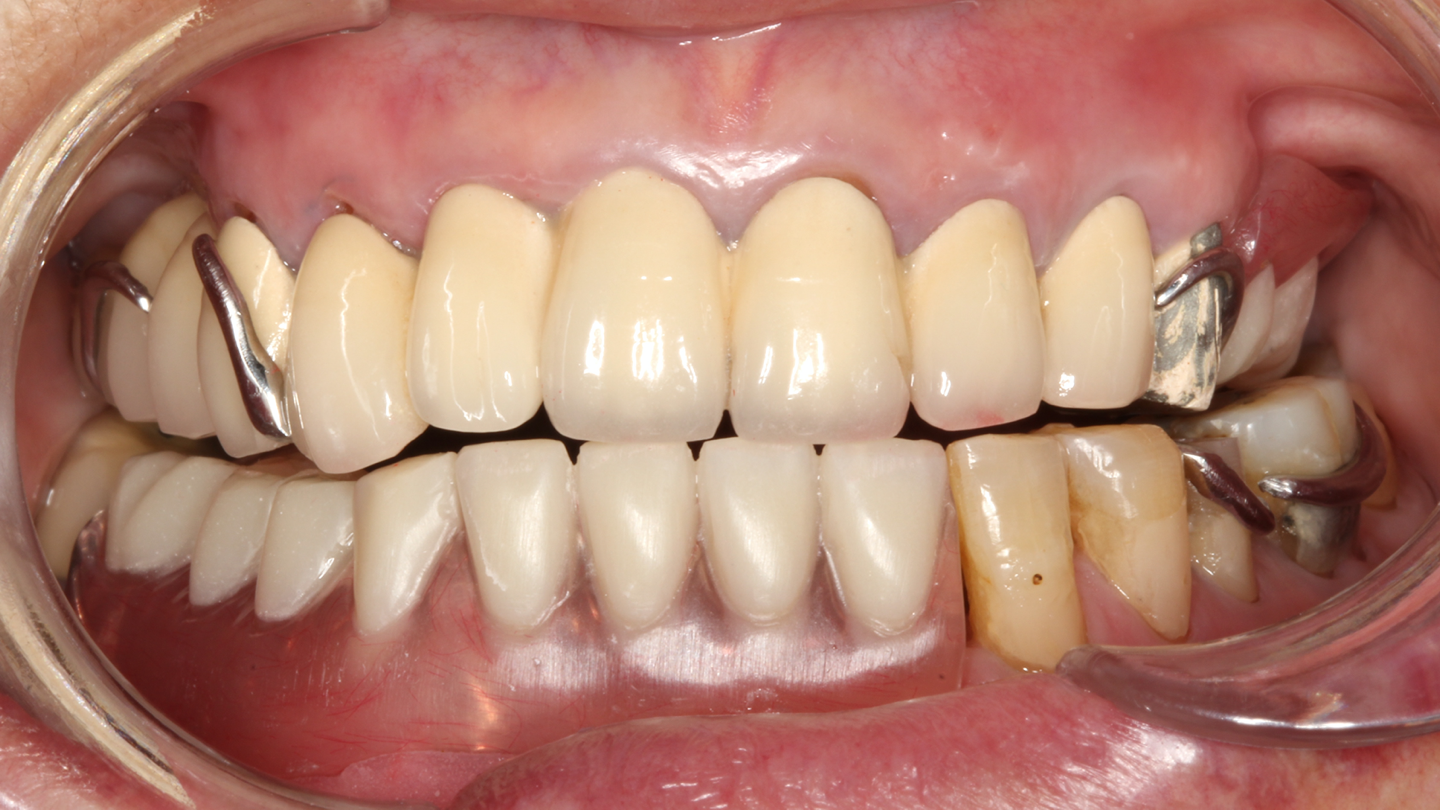 四代instant smile硅胶假牙上下牙全套包装 美白仿真牙齿假牙套-阿里巴巴