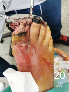 可仔细一看,才发现他的第一趾已经坏疽,且趾甲已经与甲床分离了.