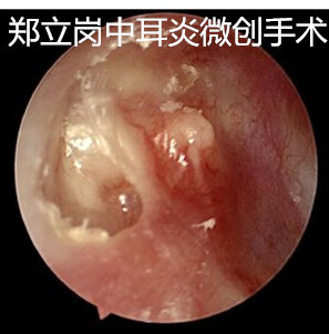 上鼓室内陷袋该怎么治疗 鼓膜内陷 鼓膜内陷