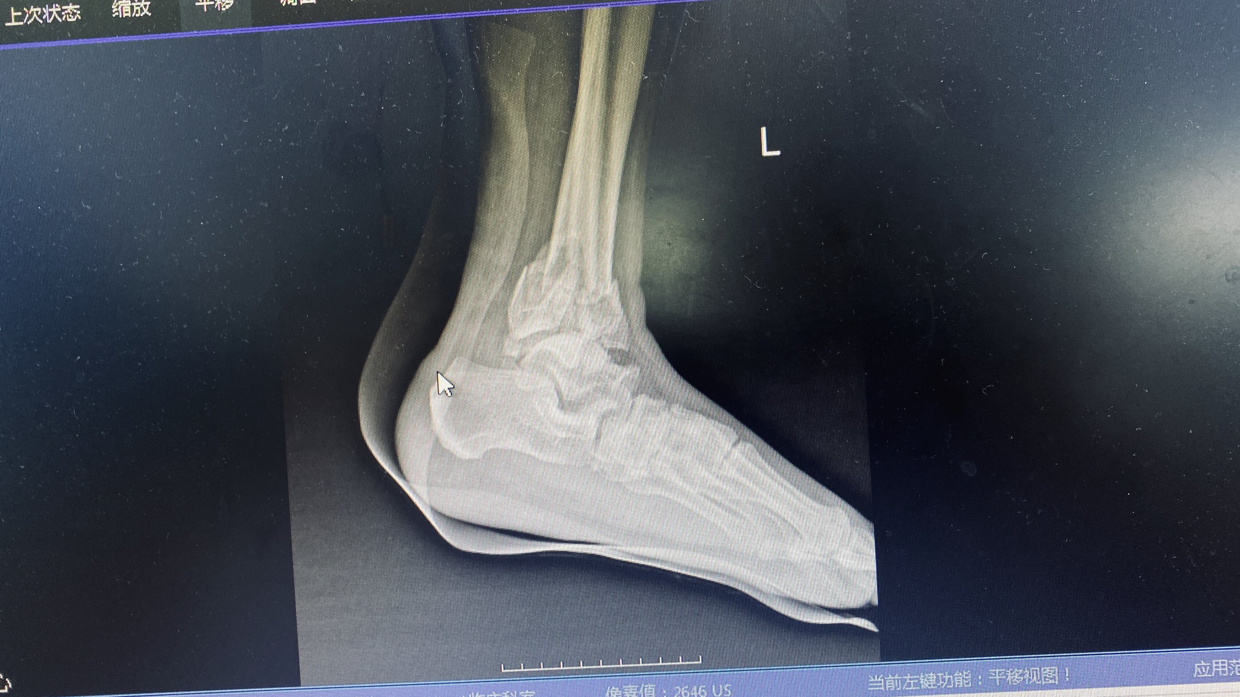 pilon骨折的完美治疗 - 好大夫在线