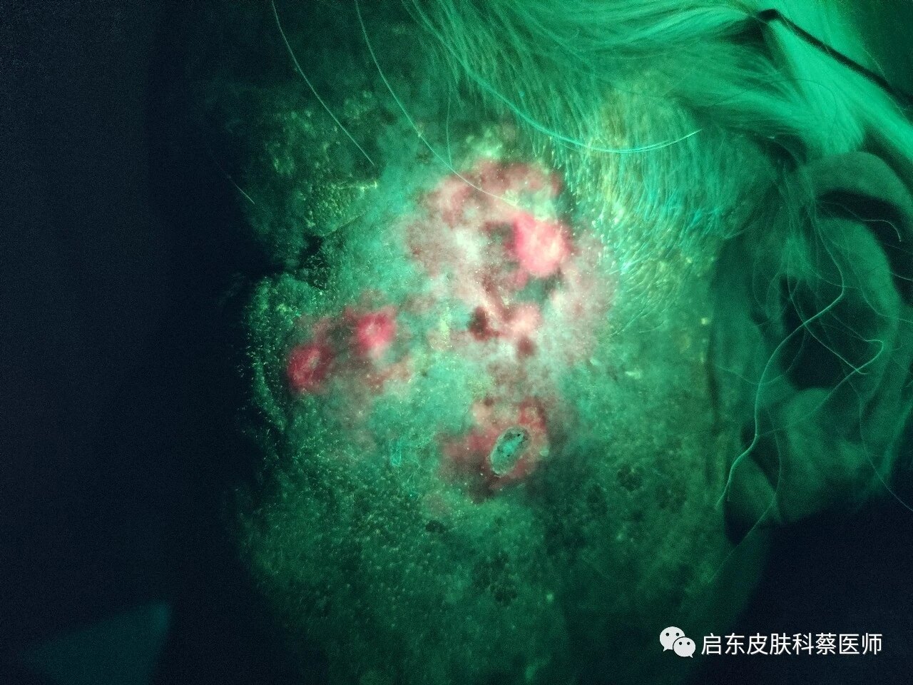 90岁的患者面部scc合并日光性角化一例_皮肤肿瘤_皮肤肿瘤治疗方式