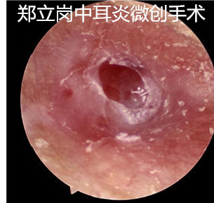 反复鼓膜炎 鼓膜增厚听力下降怎么办 耳疾病 耳疾病 反复鼓膜炎 鼓膜增厚听力下降怎么办 耳疾病 耳疾病