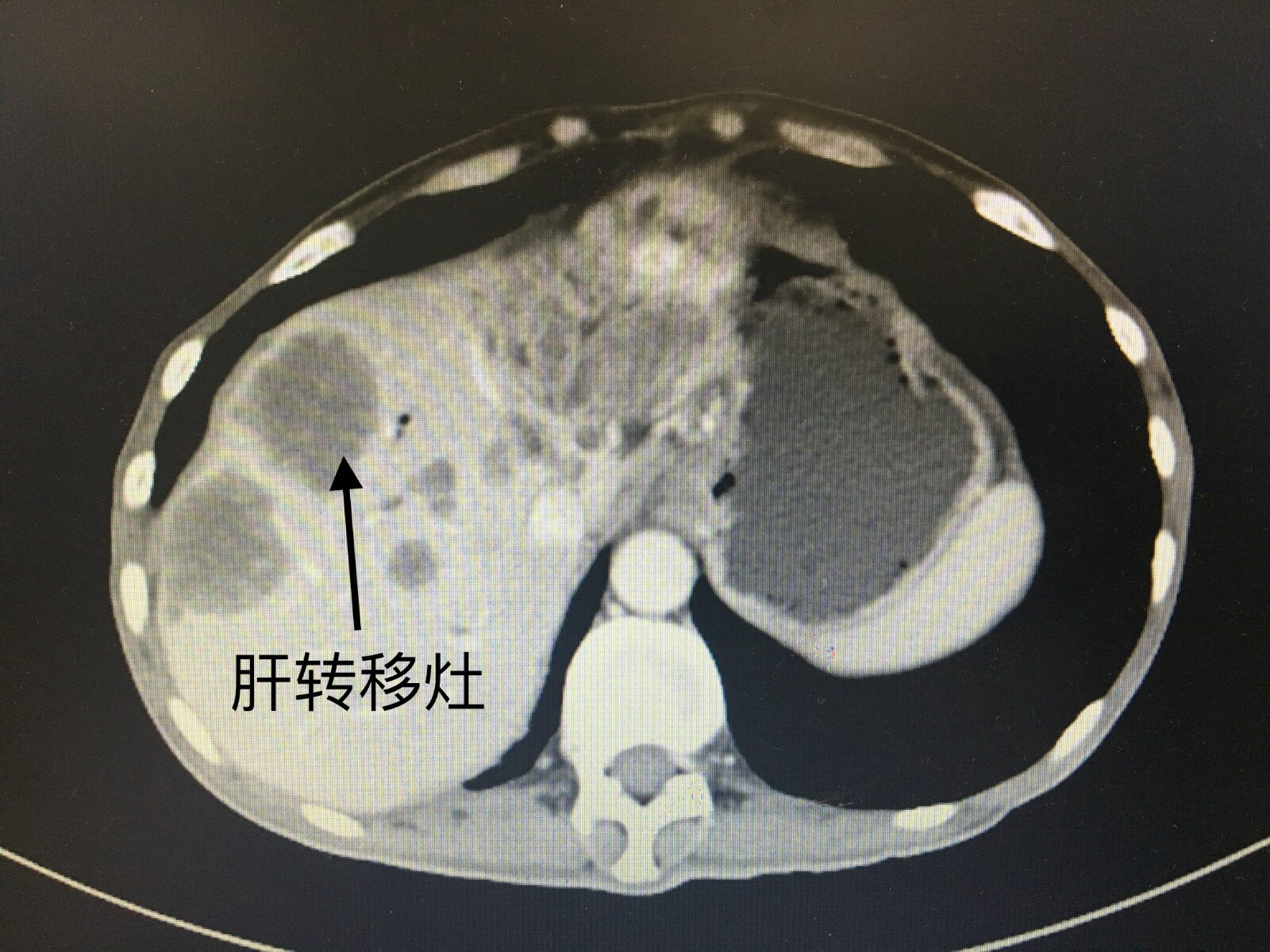 結直腸癌肝轉移的診斷