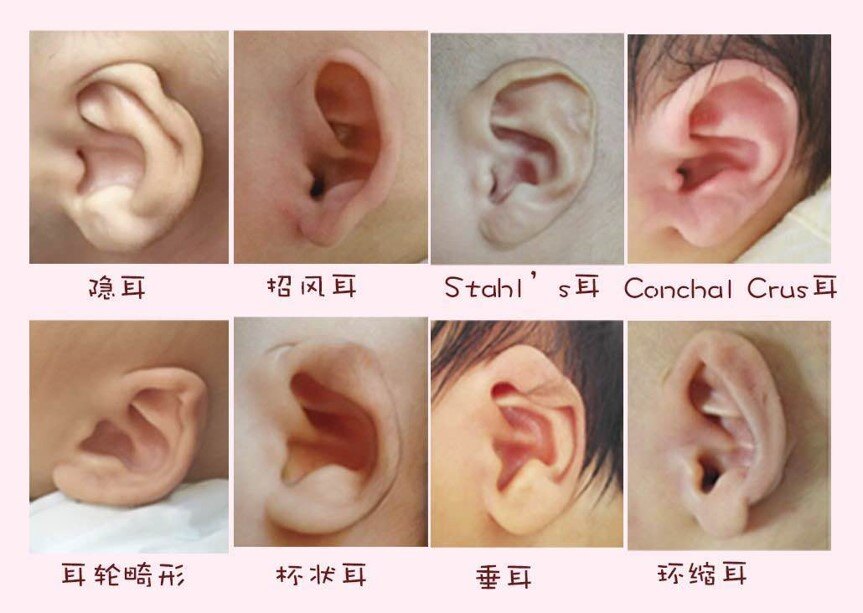 1614436720522316.jpg 耳廓畸形1.jpg