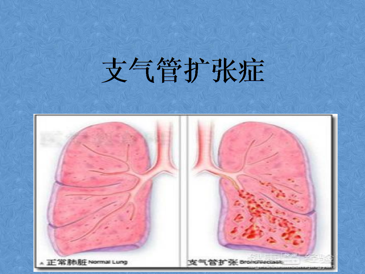 主要病因是支氣管-肺組織感染和支氣管阻塞