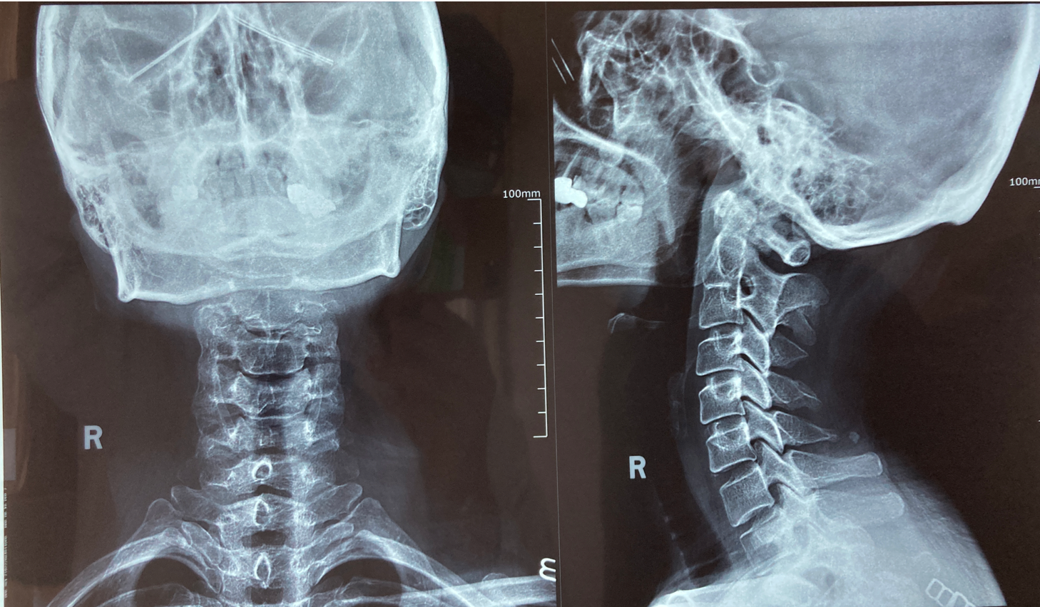 像这例颈椎病才应该及早手术 脊髓型颈椎病 脊髓型颈椎病治疗方式 好大夫在线 像这例颈椎病才应该及早手术 脊髓型颈椎病 脊髓型颈椎病治疗方式 好大夫在线