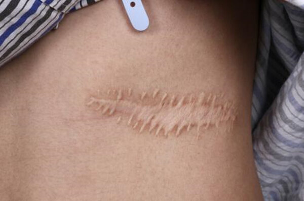 乳腺癌切除后疤痕图片