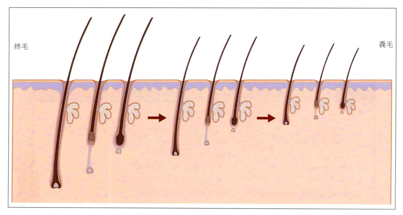 毛囊退化图片