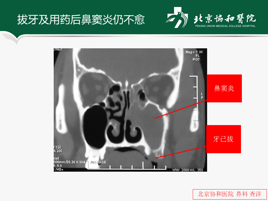 牙源性鼻竇炎患者手術常見問題及注意事項_鼻竇炎_症狀表現_治療方式