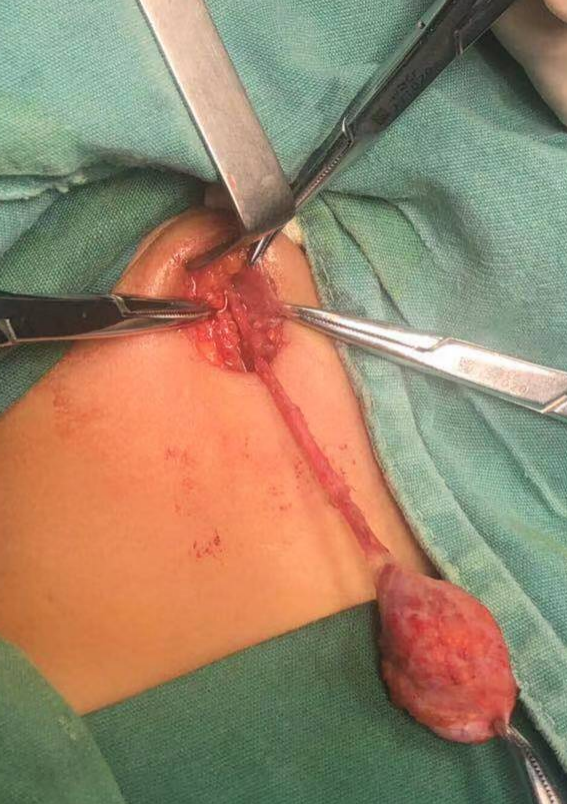 鳃裂瘘管手术疤痕图片图片