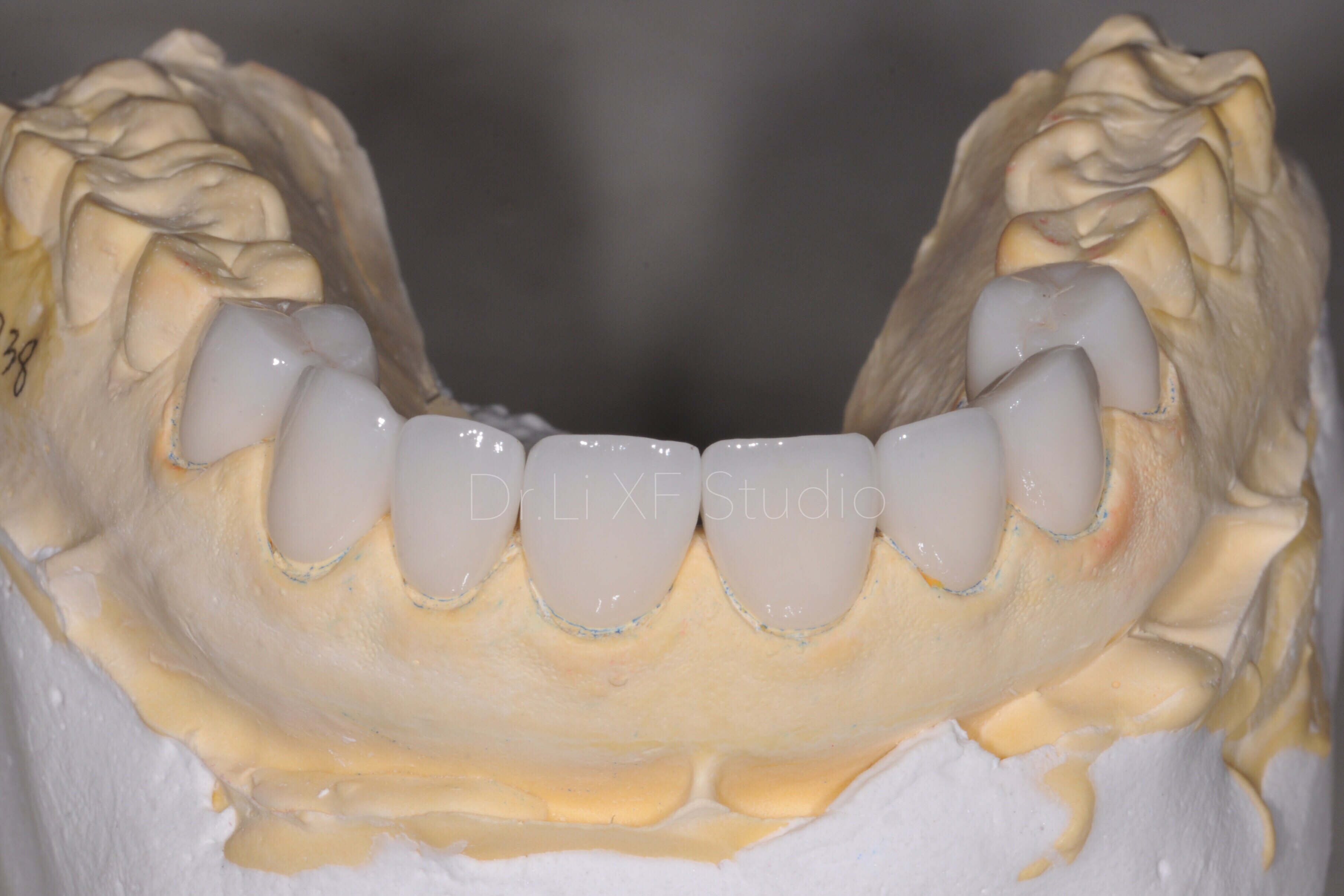 前牙美学修复_口腔修复_口腔修复治疗介绍 - 好大夫在线