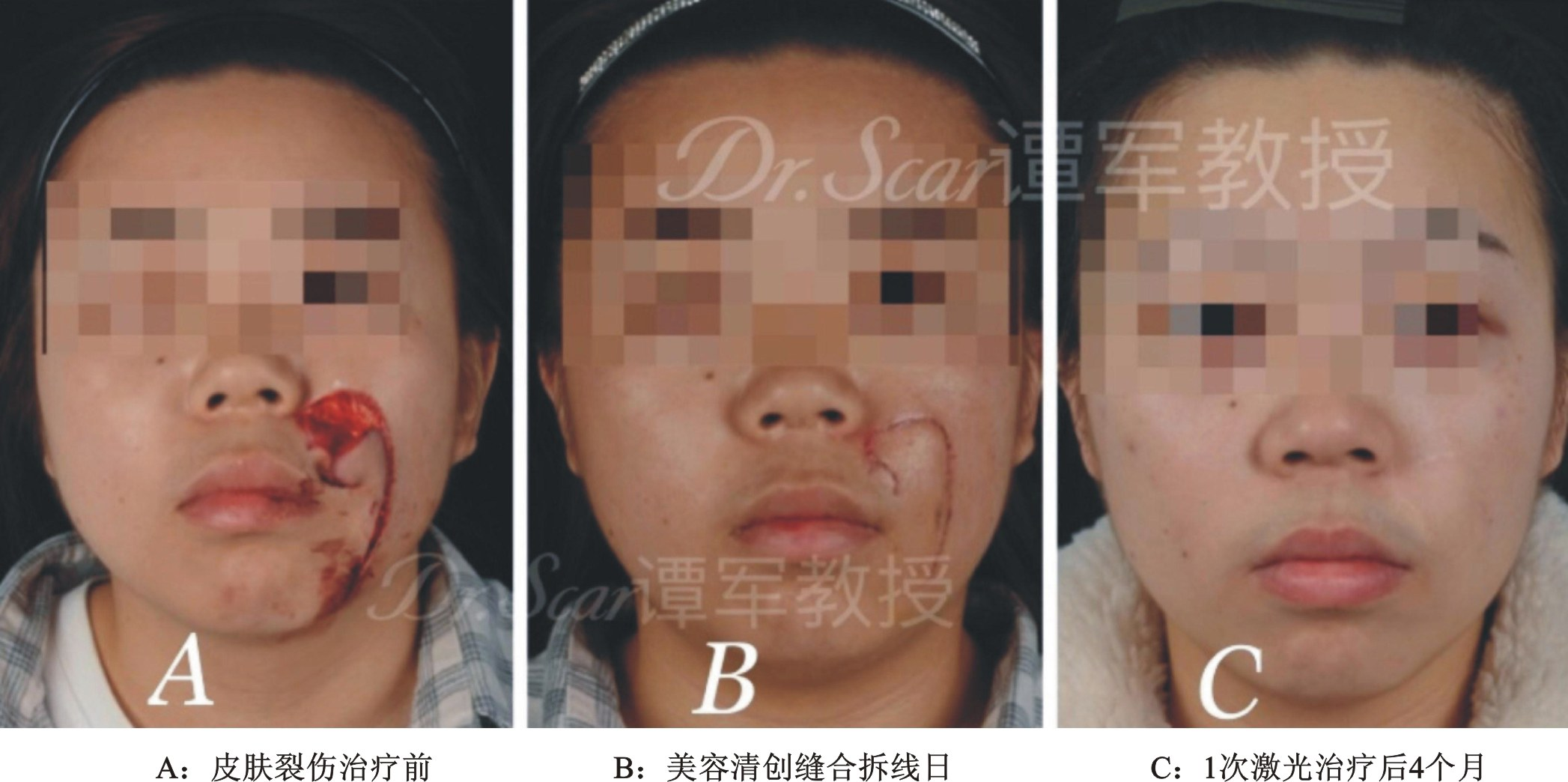 增生性瘢痕的激光-皮肤再生修复(二)_疤痕_疤痕治疗方式 - 好大夫在线