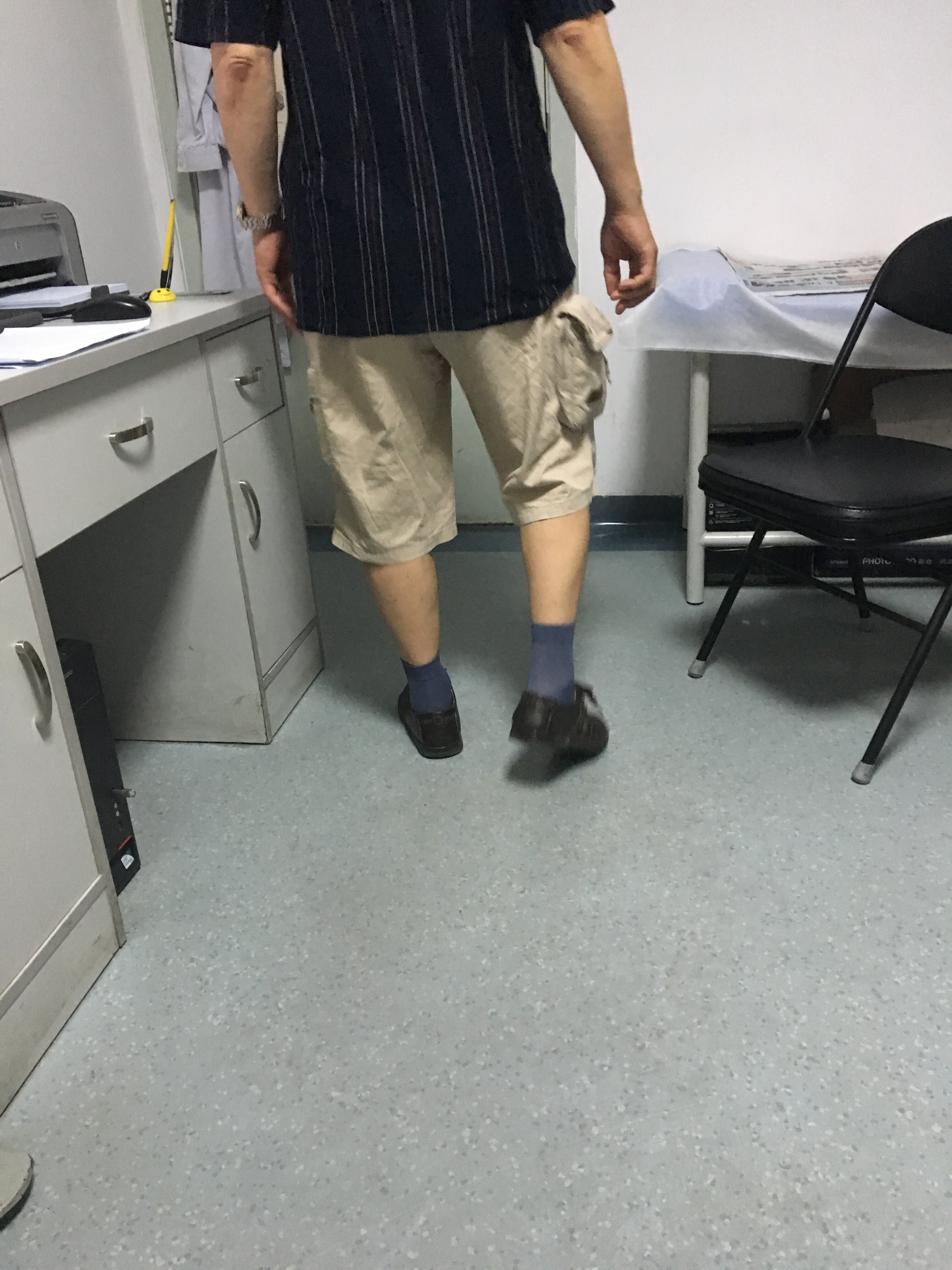 许多患者的所谓 肌肉萎缩 与 渐冻症 根本没有毛线关系 肌肉萎缩