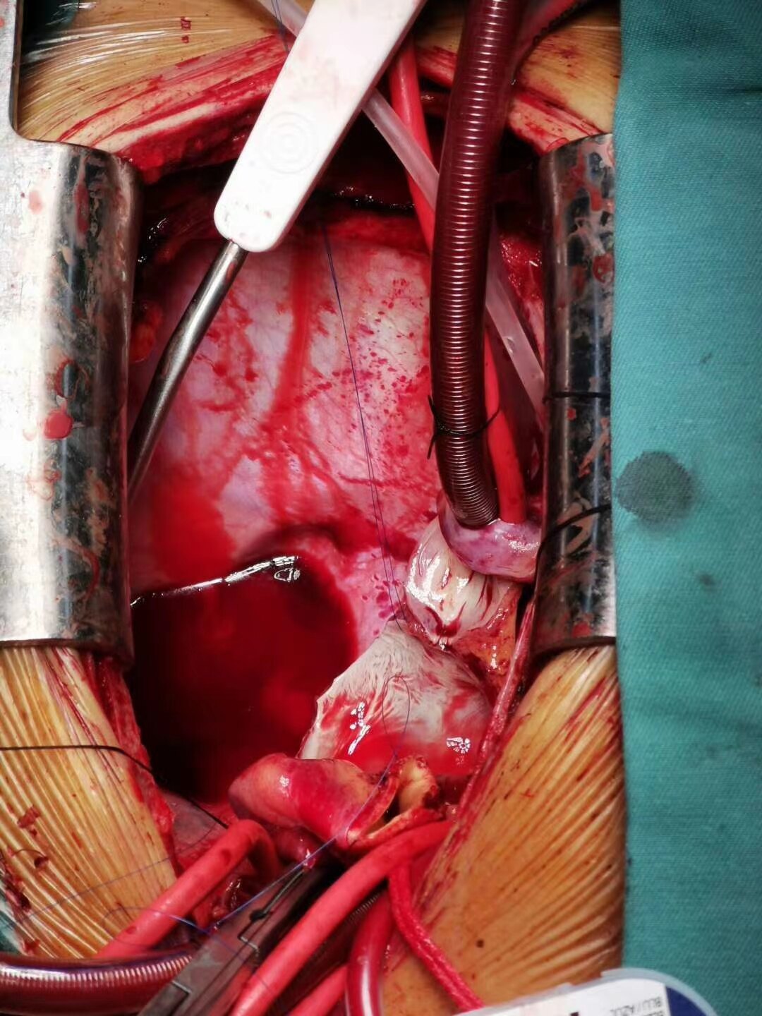 南京市第一医院心脏外科完成第100例心脏移植手术 - 好大夫在线