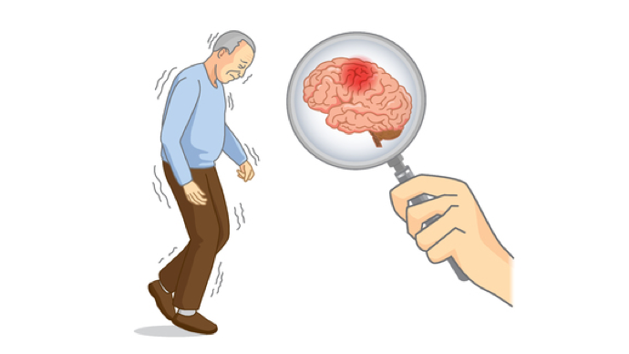 帕金森病患者逐渐出现抑郁焦虑怎么办?