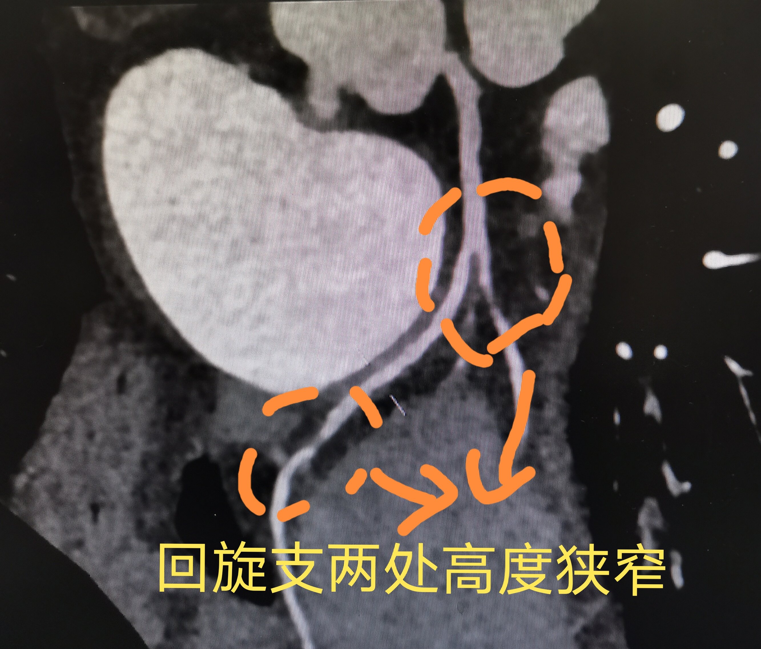 前降支開口只剩一根絲,右冠開口高度狹窄,粗大優勢的迴旋支也