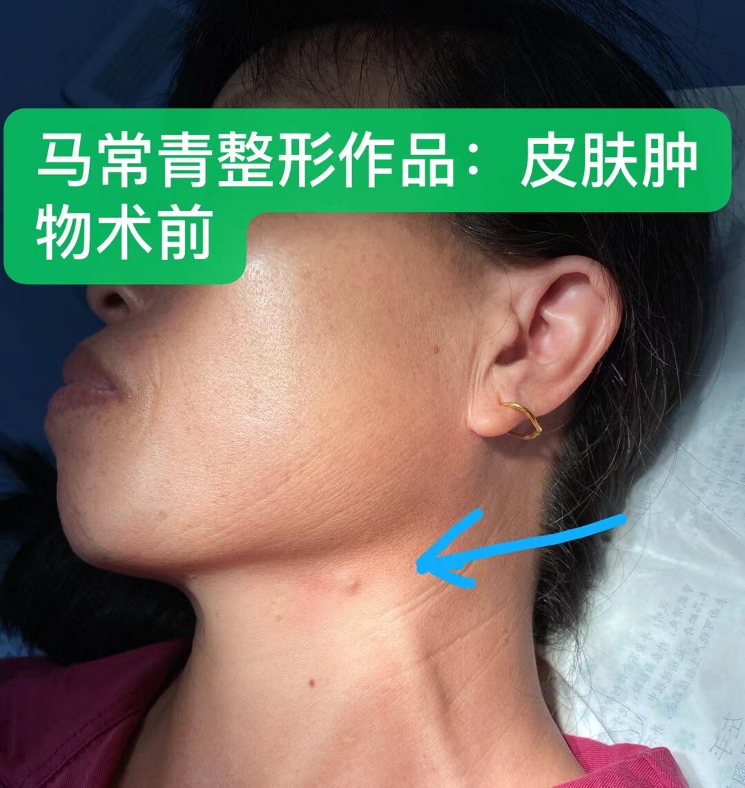 莫把皮肤小肿物不当回事 可能就是皮肤癌 皮肤癌 皮肤癌 莫把皮肤小肿物不当回事 可能就是皮肤癌 皮肤癌 皮肤癌