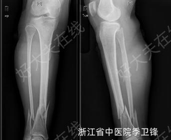 微创胫腓骨骨折内固定 胫腓骨骨折 好大夫在线