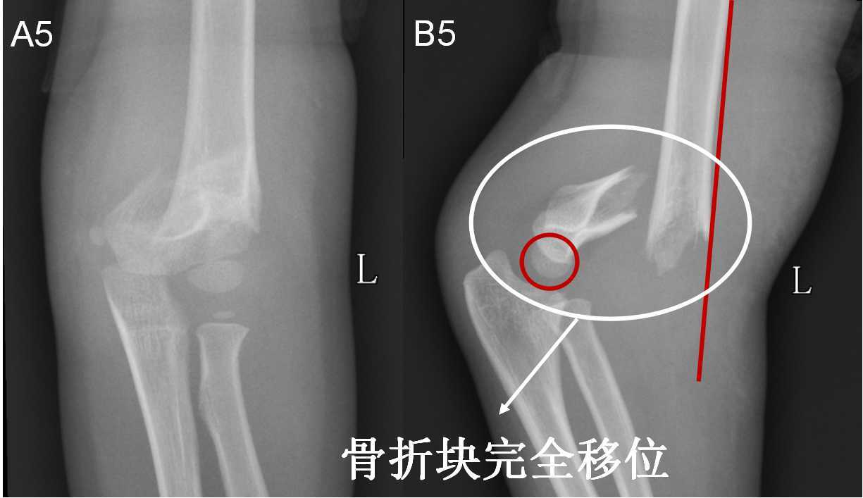 一分钟让您明白肱骨髁上骨折什么时候要手术 什么时候不用手术 肱骨骨折 肱骨骨折