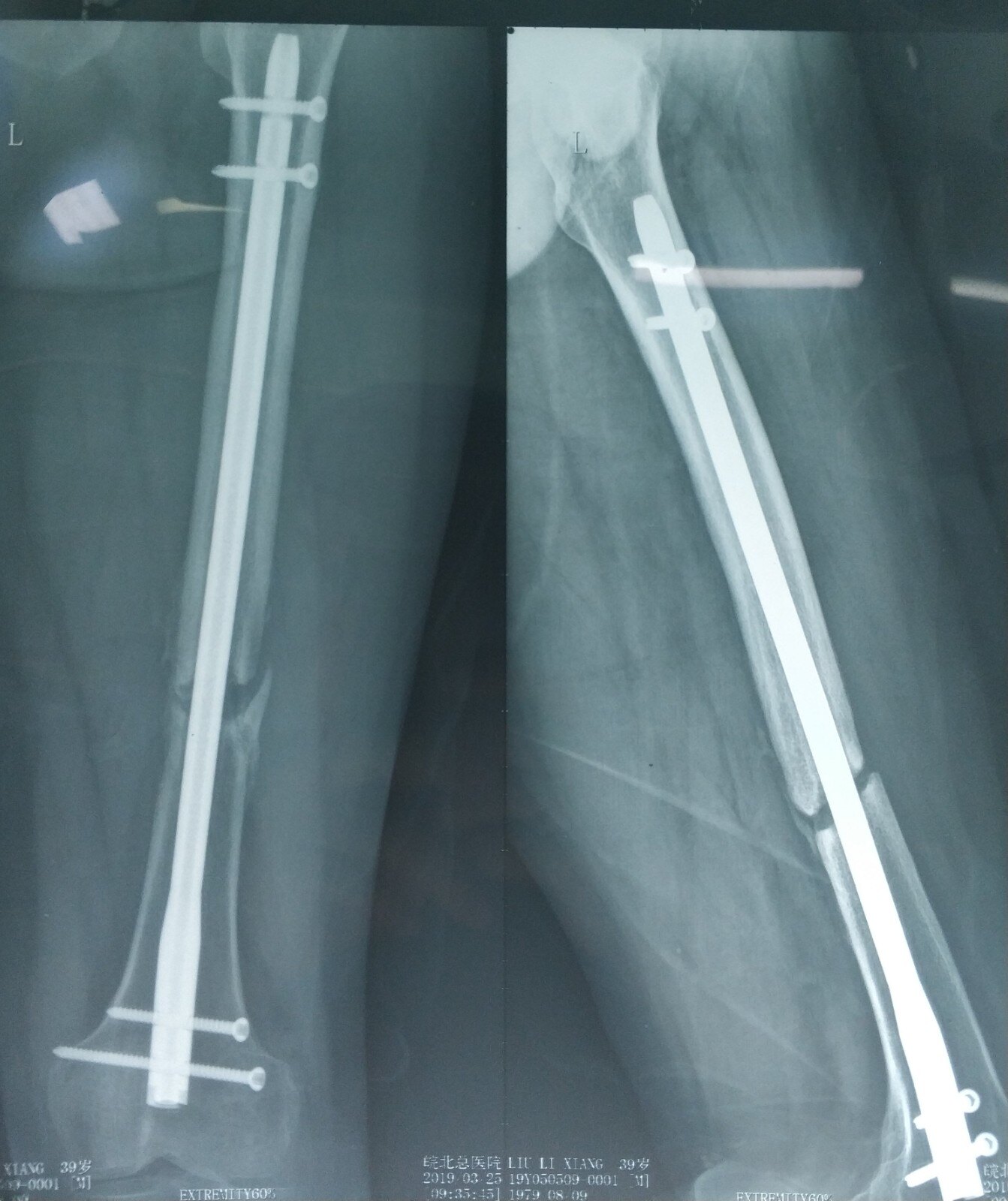 患者因股骨幹骨折在外院行髓內釘治療,出現骨不連採取取髂骨植骨鋼板