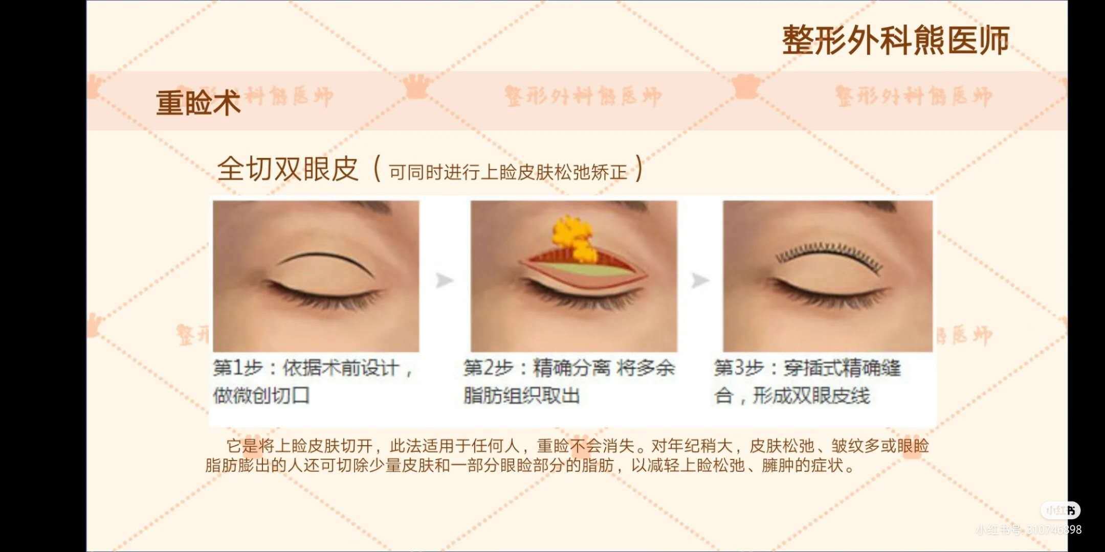 拯救眼周老化之重睑术加上睑皮肤松弛矫正 双眼皮手术 双眼皮手术