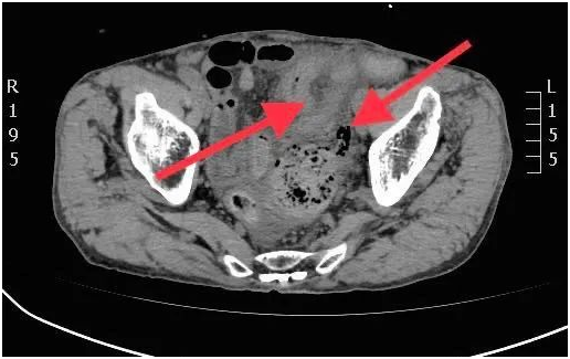 ct影像肠壁增厚水肿ct提示患者乙状结肠肠壁增厚,局部明显水肿,周围