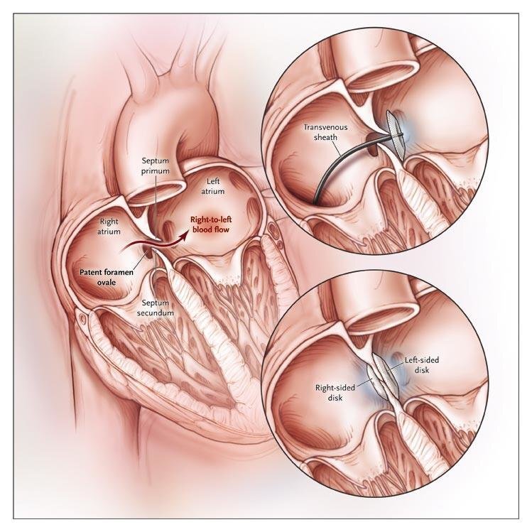Percutaneous-Closure-of-a-Patent-Foramen-Ovale-With-use-of-a-femoral-approach-a.png