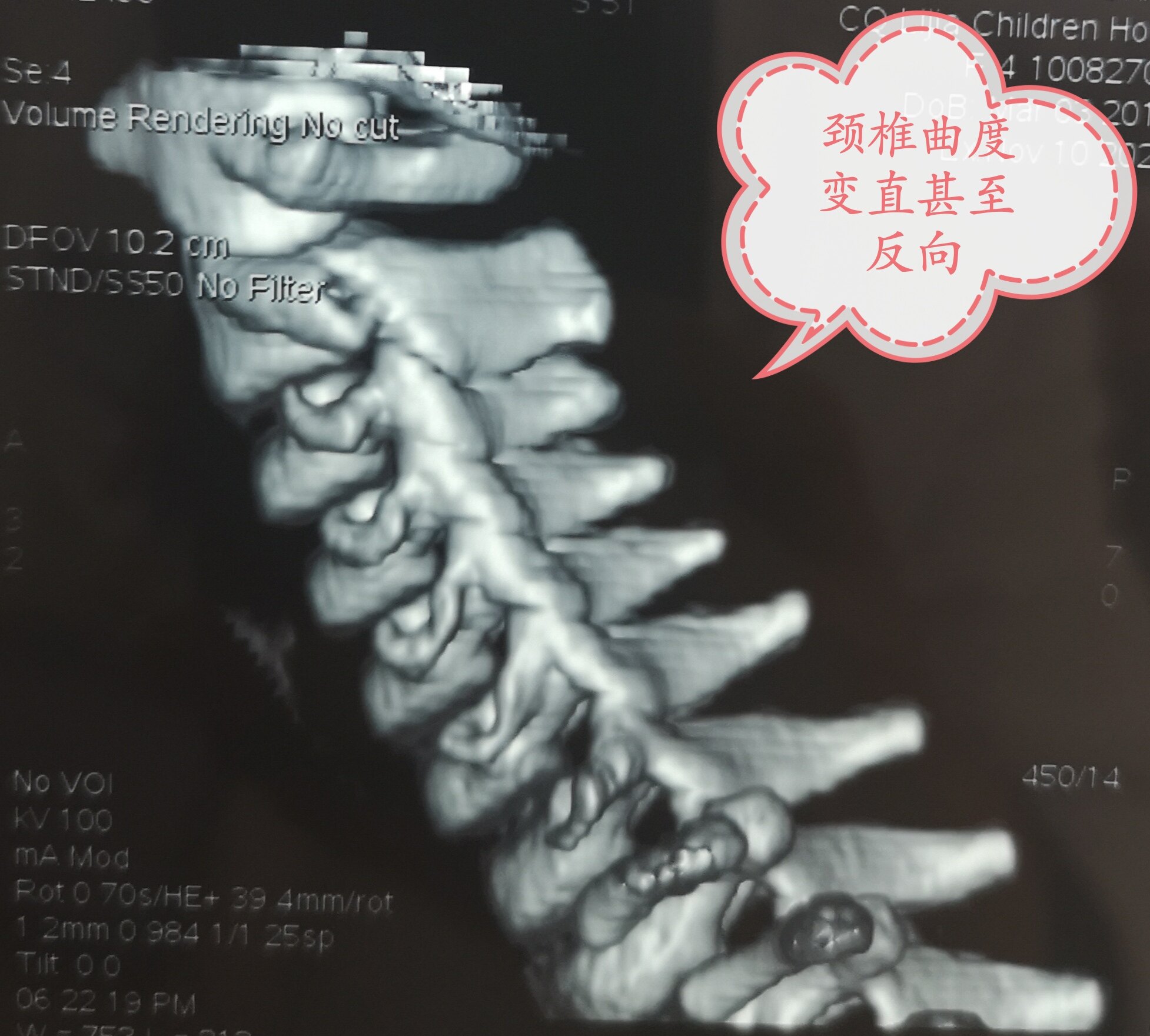 颈椎椎体滑脱图片